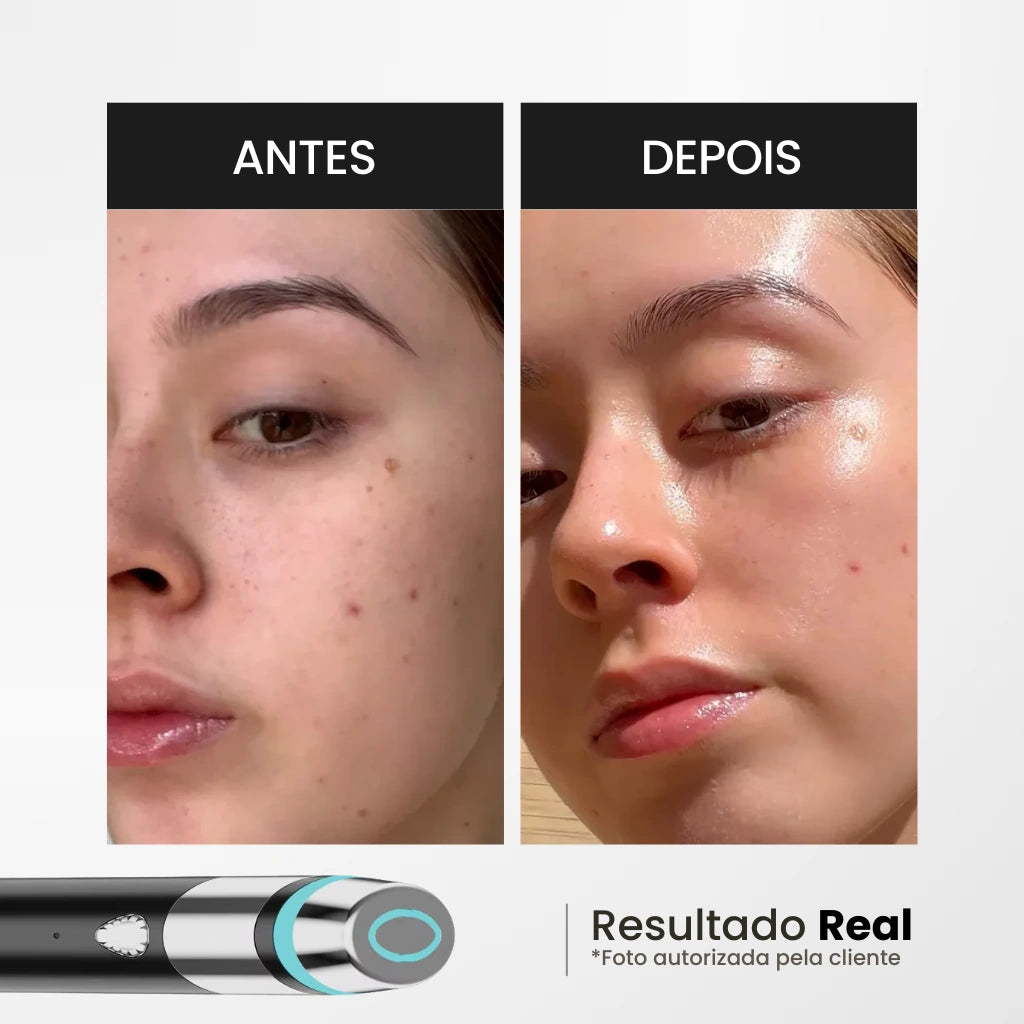 AGE Booster Pro: Dispositivo Coreano de Cuidado Facial